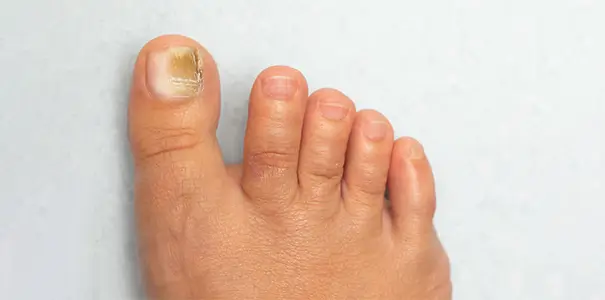 Nail Disorders