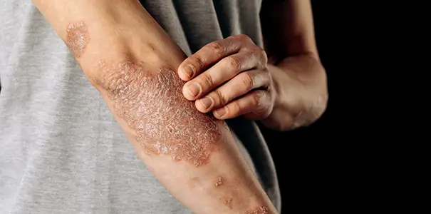 Psoriasis