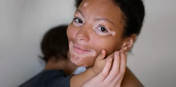 Vitiligo