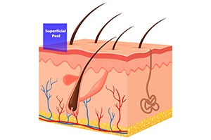 Superficial Peels