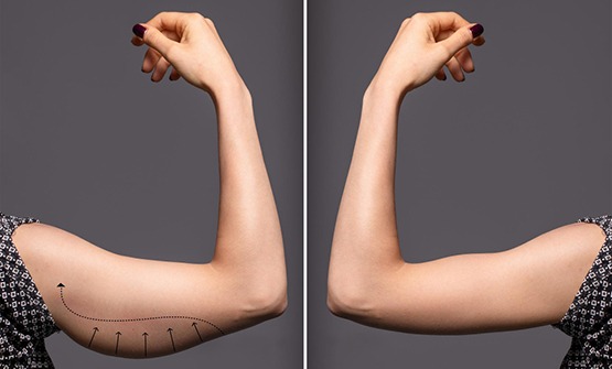 Fat Loss Injections result