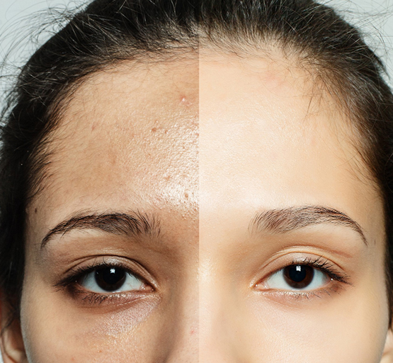 Glass Skin Peel How It Works