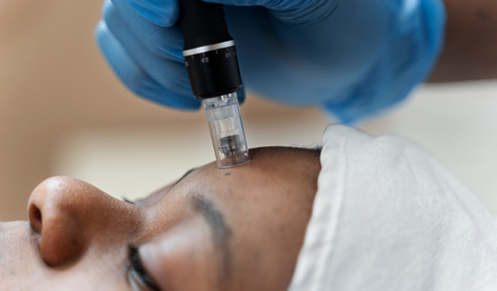 Microneedling