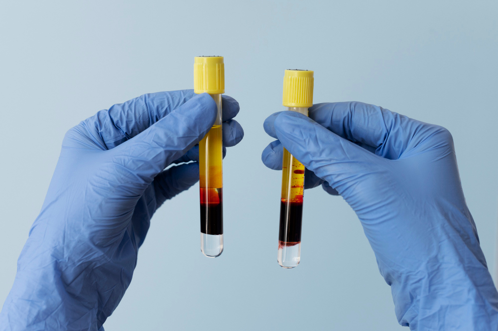 Platelet Rich Plasma