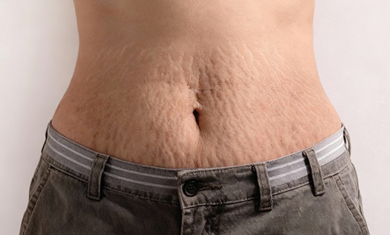Stretch Mark Treatment who can do it