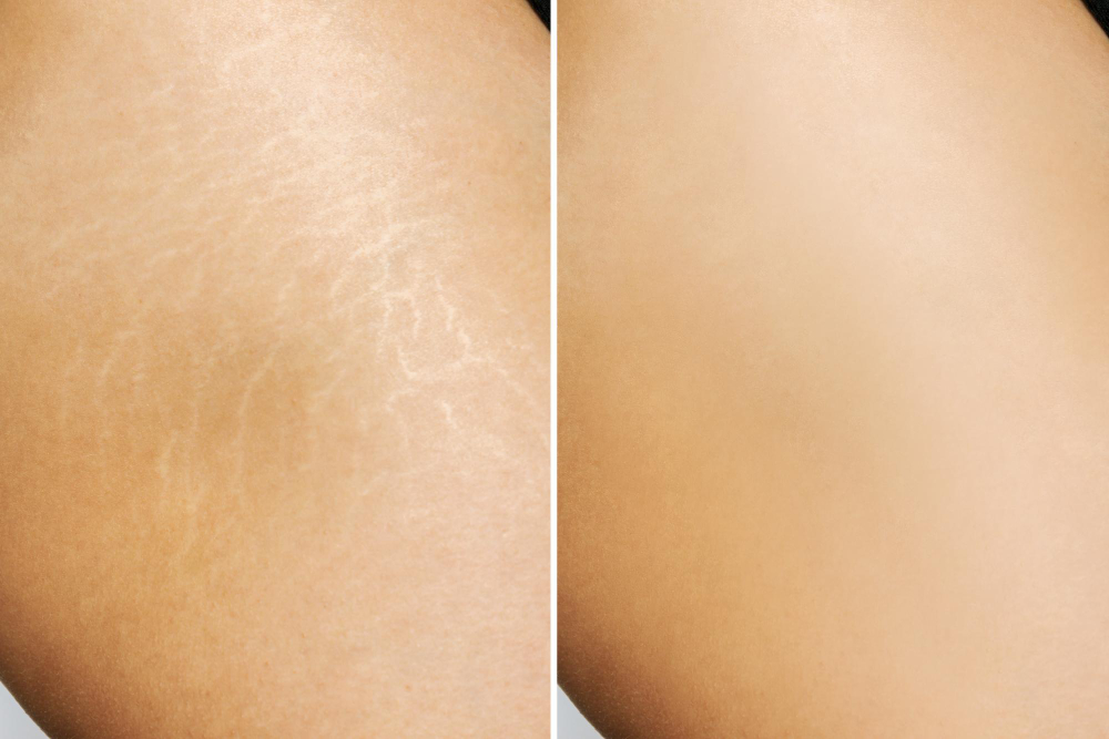 stretch mark treatment result